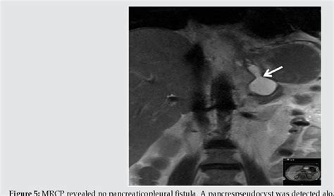 Figure 1 From Necrotizing Pancreatitis With Mediastinal Abscess