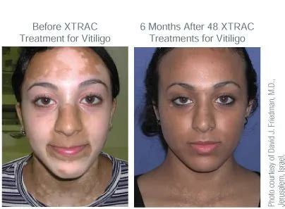 XTRAC Dermatologist In Coraopolis Pittsburgh Three Rivers Dermatology