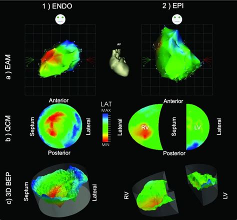 Quantitative Analysis Of Electro Anatomical Maps Application To An