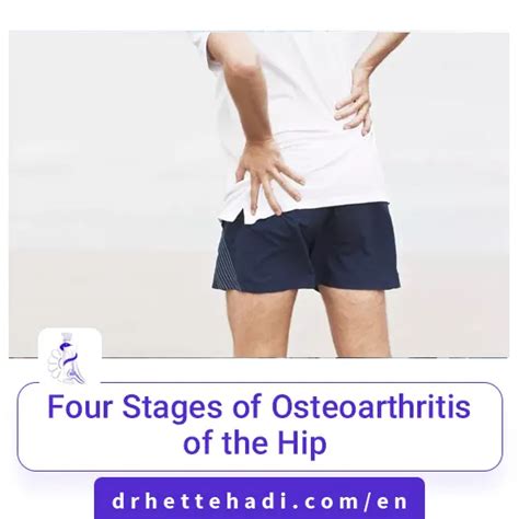 Four Stages Of Osteoarthritis Of The Hip Dr Hossein Ettehadi