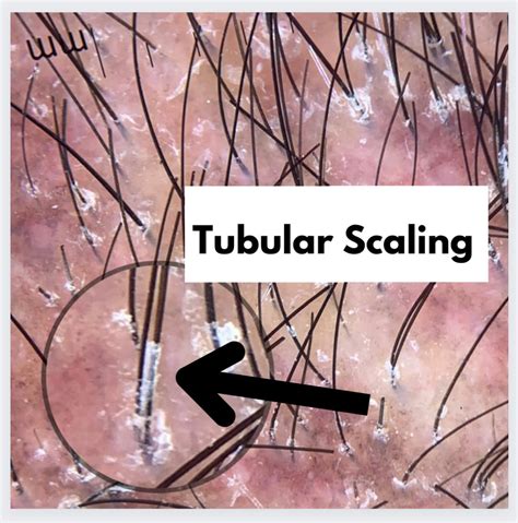 Tubular Scaling in Lichen Planopilaris (LPP) — Donovan Hair Clinic