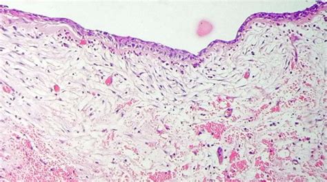 Dentigerous Cyst Histology