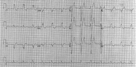 Conduction Blocks And Cardiac Pacing Thoracic Key