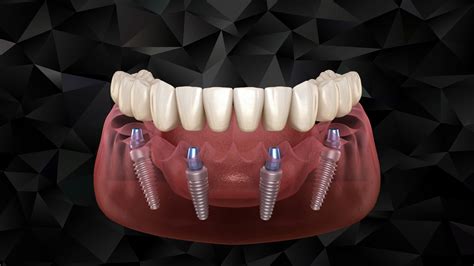 All-on-4 implant - Bagcilar Dental Clinic