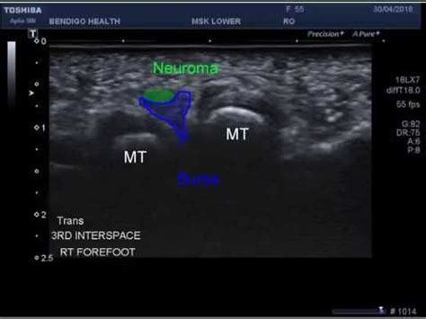 Inter Metatarsal Bursa