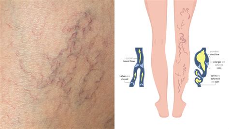 6 Causes of Spider Veins and Tips to Prevent Them