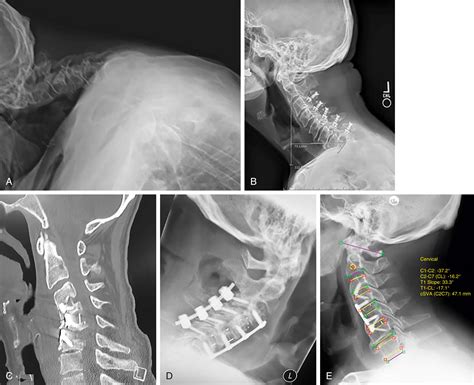 Postoperative Spinal Deformity Clinical Tree