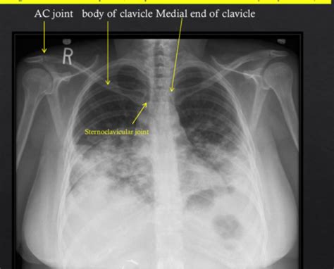 Pulmonology Quiz 1 Pulmonary Embolism And Radiology Flashcards Quizlet