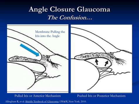 Signs and symptoms of acute angle closure glaucoma. Acute Angle Closure ...