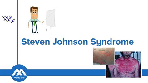 Stevens-Johnson Syndrome – Dermatology | Lecturio | steven johnson ...