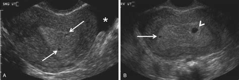 Ectopic Pregnancy Radiology Key