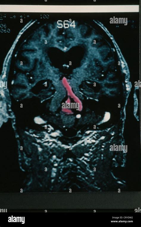 ANEURYSM OF THE BRAIN, MRI Stock Photo - Alamy