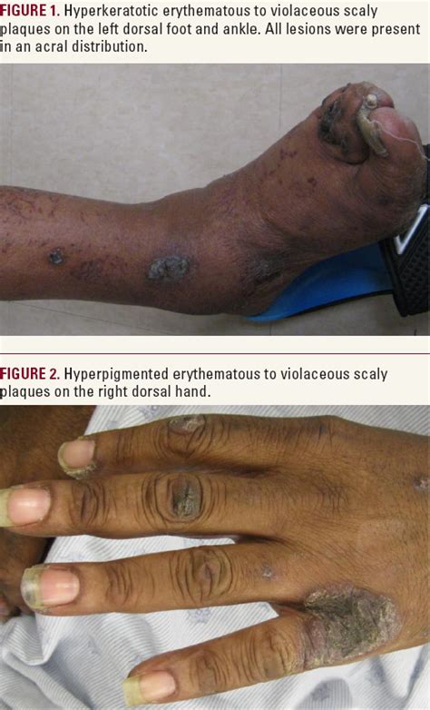 Necrolytic Acral Erythema