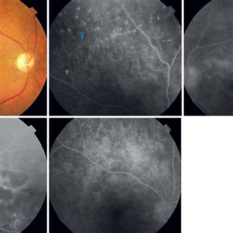 Color Fundus And Fluorescein Angiogram Findings In A Patient With