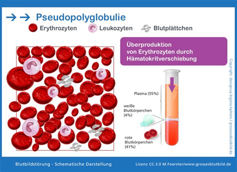 Polyglobulie Erythrozytose Erh Hte Erythrozytenanzahl Im Blut