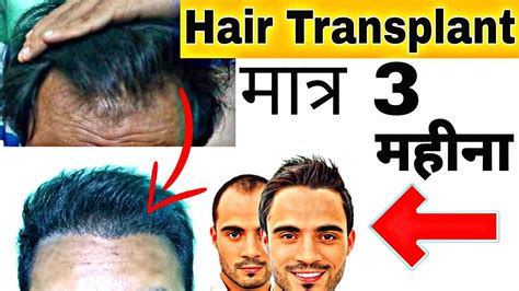 Fastest Hair Transplant Result Hair Transplant In India My Hair