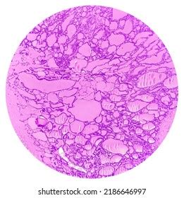 Synovial Sarcoma Histology Image Analyzed By Stock Photo 2186646997 ...