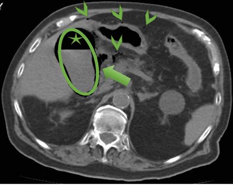 Emphysematous Cholecystitis Causes Symptoms Diagnosis And Treatment