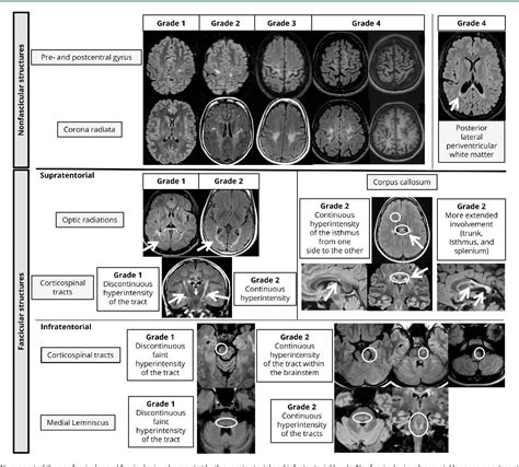 Figure 1 From Brain Mri Features And Scoring Of Leukodystrophy In Adult