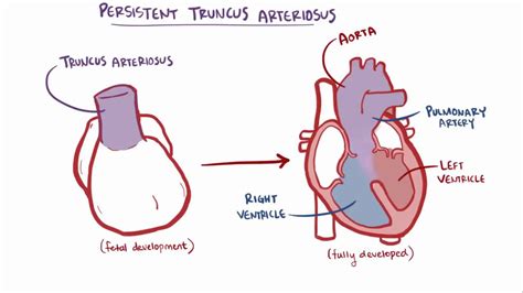 Truncus Arteriosus Video Anatomy And Definition Osmosis