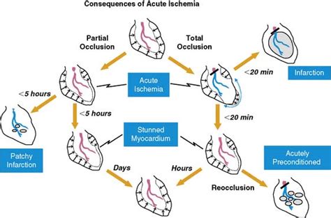 Pathophysiologic Basis Of Hibernating Myocardium Thoracic Key