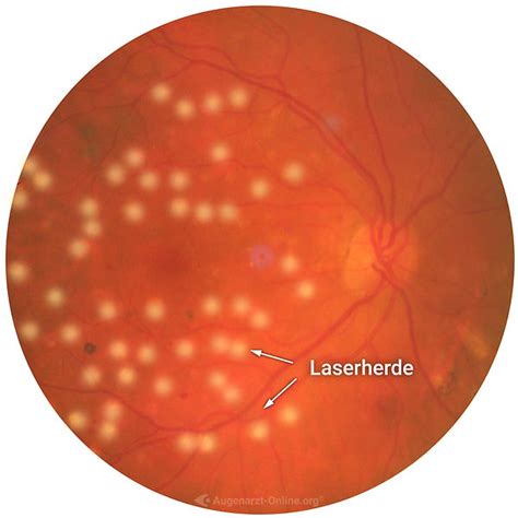 Makula Grid Laser Makula Fundus Trainer