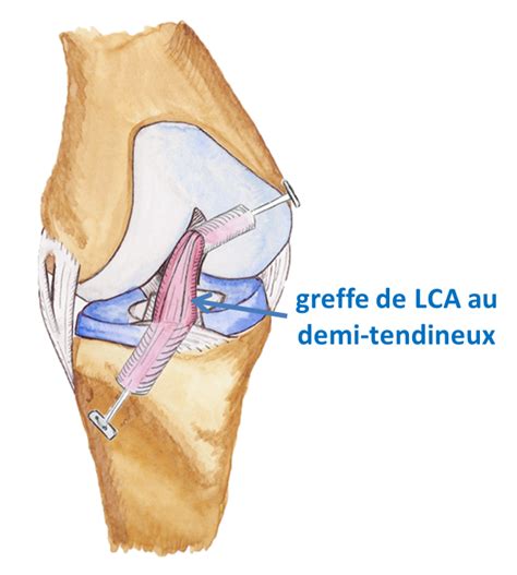 ligamentoplastie ligament croisé antérieur Dr Felden réunion 974