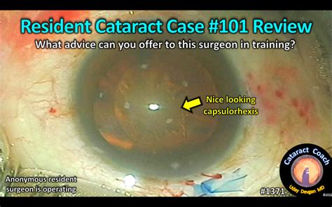 1371 Resident Cataract Case 101 Review Cataract Coach™