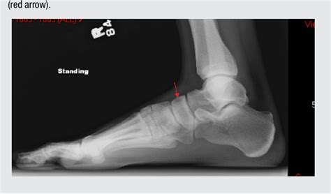 Figure 1 From Arthroscopically Assisted Treatment Of Navicular