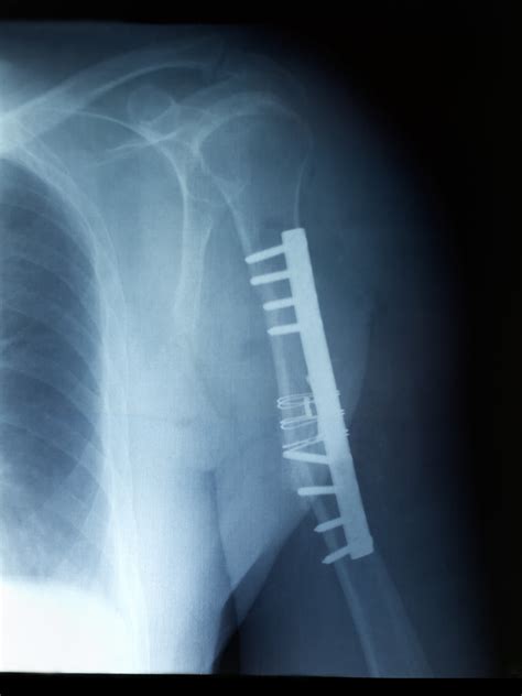 Arm Bone Fracture Surgery at Andrew Rhone blog
