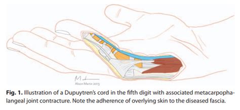 Enfermedad De Dupuytren Y Fisioterapia Cl Nica En Lugo Cl Nica Reactive