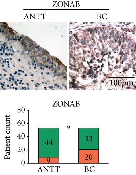 The Expression Of Tight Junction Proteins Is Altered In Bladder Cancer