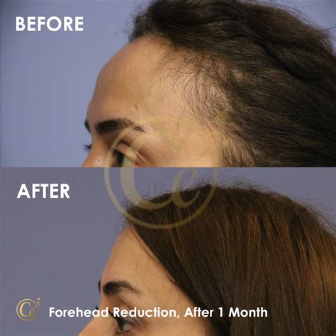 Forehead Reduction In Turkey Results Dr Cengizhan Ekizceli