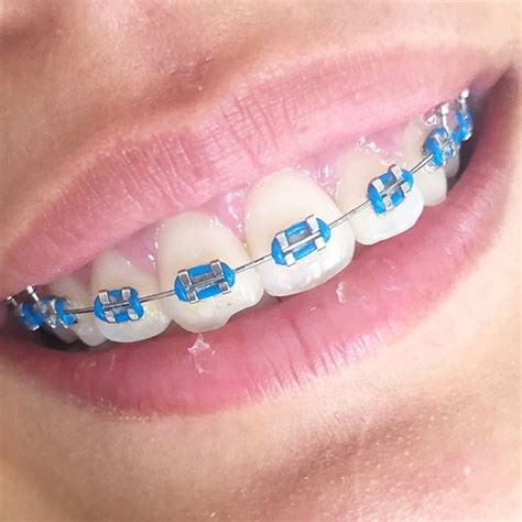 The Best Braces Colors For Girls To Wear Braces Explained