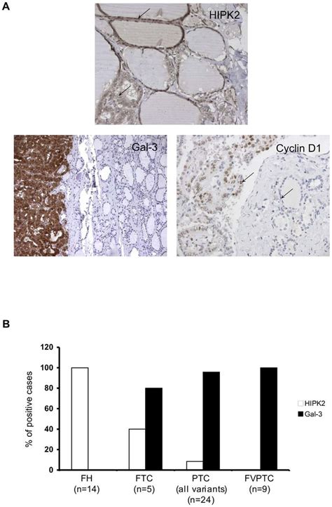 Inverse Correlation Between Hipk And Gal Expression In Wdtcs A