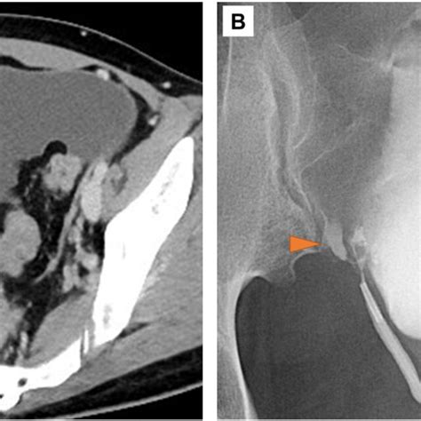 Intraoperative View Of The Boari Flap Anastomosis And Postoperative