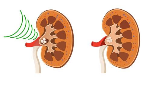 Urologista Goiânia Livre se das pedras nos rins sem cirurgia