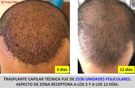 Dermatolog A Madrid Cu Nto Cuesta Un Injerto Capilar