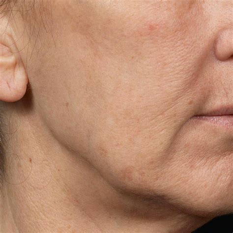 Fraxel Laser Before After Photos Treatment Gallery Results