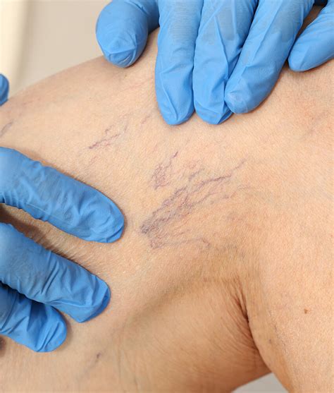 Spider Veins Doctor Vein