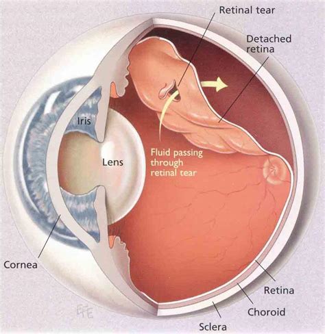 Retinal Detachment Outlook Eye Specialists