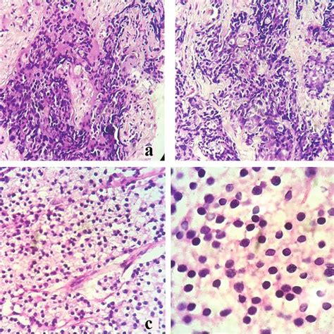 Core Needle Biopsy Of The Right Breast Mass Revealing Infiltrating Download Scientific Diagram