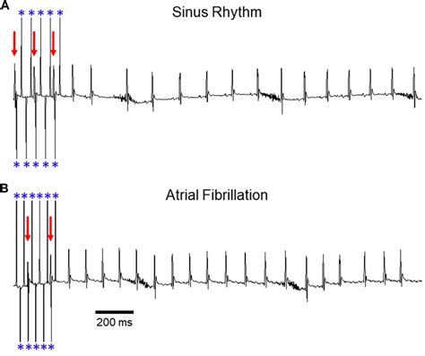 Frontiers Overview Of Programmed Electrical Stimulation To Assess Atrial Fibrillation