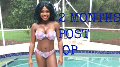 2MONTHS POST OP RECOVERY PLASTIC SURGERY/TUMMY TUCK/ HERNIA/BREAST ...