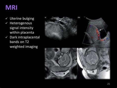 Morbidly Adherent Placenta For Apan39