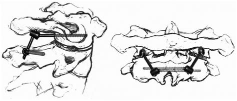 Radial Head Dislocation Teachme Orthopedics