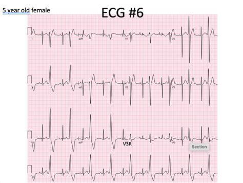 Need Some Help With This ECG R ECG