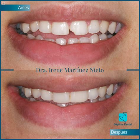 Carillas Dentales Para Lucir Una Sonrisa Natural Top Doctors