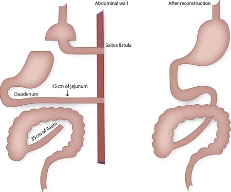 Restoration Of Enteroendocrine And Pancreatic Function After Internal Hernia And Short Bowel