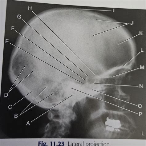 Lateral Xray Diagram Quizlet